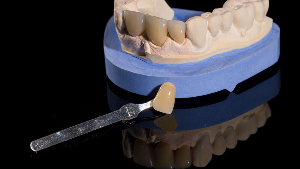 Merlin-dental-laboratory_Service_custom-shades